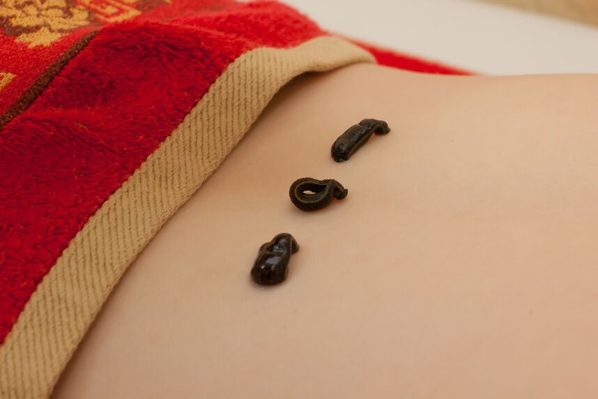 Leeches on the lower back with osteochondrosis
