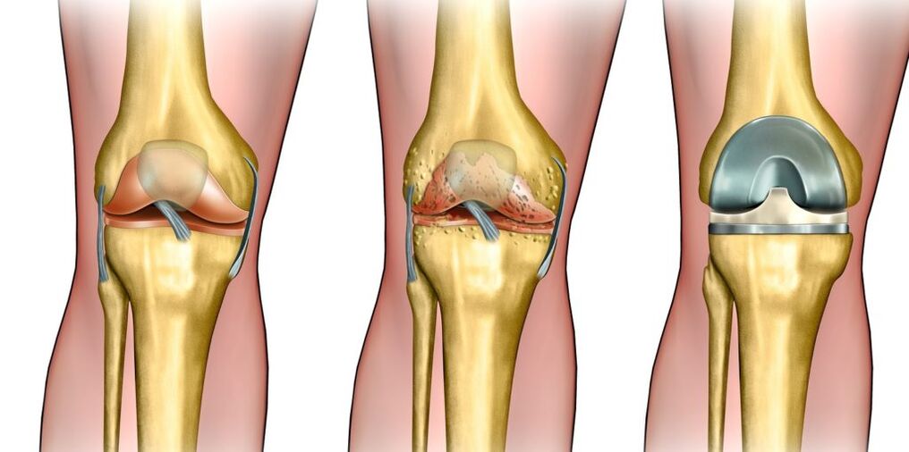 Arthrosis of the knee joint